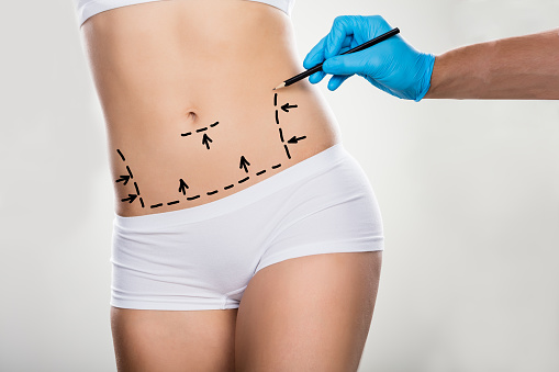 Liposuction vs Tummy Tuck in Norwich, CT