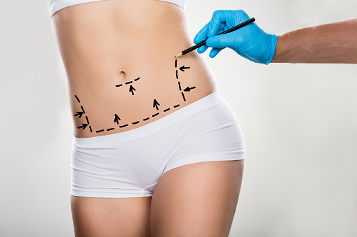 Liposuction in Norwich, CT