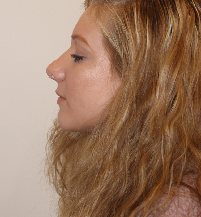 Rhinoplasty Before and After Pictures in Norwich, CT