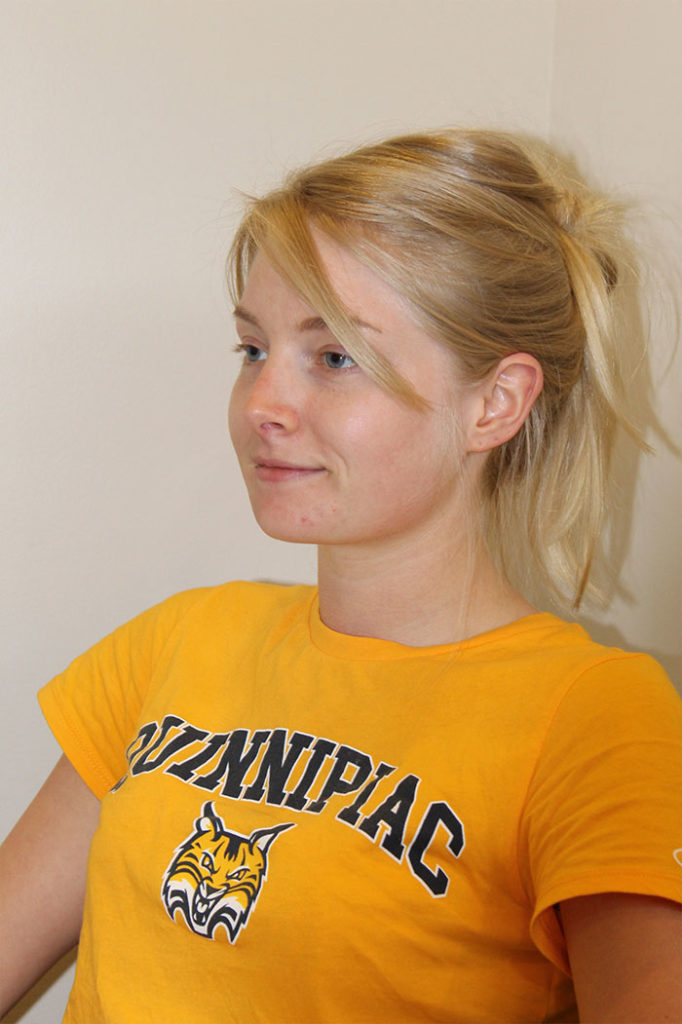 Facial Liposuction Before And After Pictures Norwich, CT