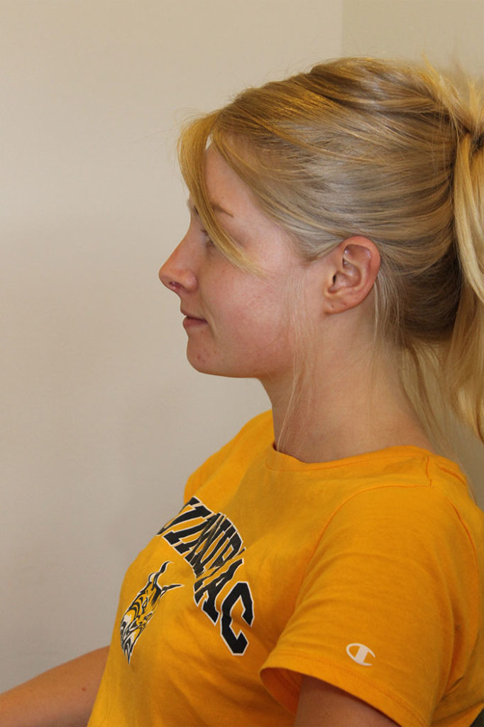 Facial Liposuction Before And After Pictures Norwich, CT