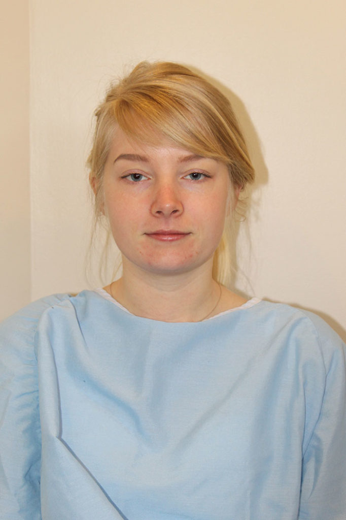 Facial Liposuction Before And After Pictures Norwich, CT