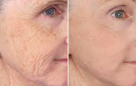 Vivace™ RF Microneedling in Norwich, CT