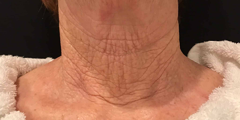 Vivace™ RF Microneedling Before And After Pictures In Norwich, CT