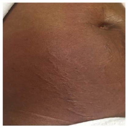 Vivace™ RF Microneedling Before And After Pictures In Norwich, CT