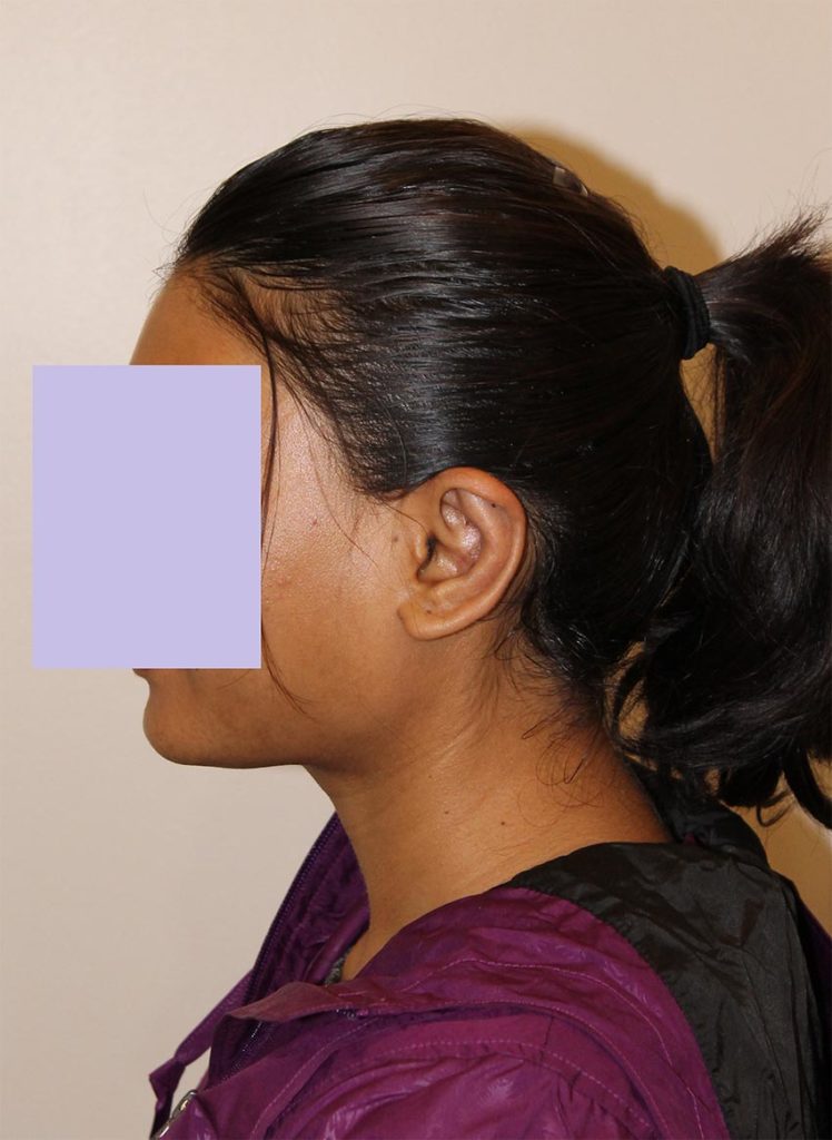 Otoplasty Before and After Pictures Norwich, CT
