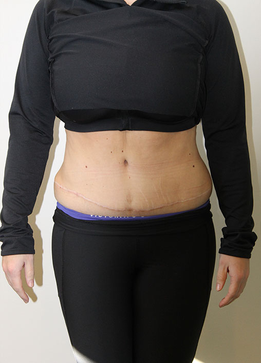 Tummy Tuck Before And After Pictures In Norwich, CT