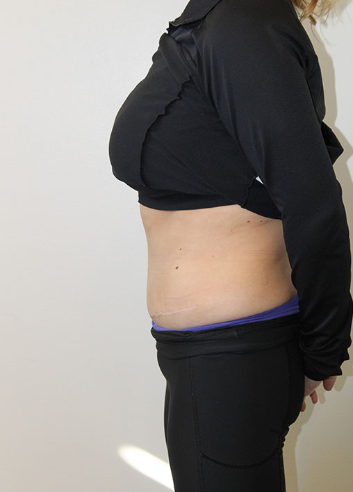 Tummy Tuck Before And After Pictures In Norwich, CT