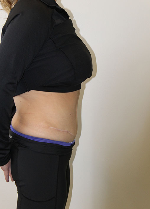 Tummy Tuck Before And After Pictures In Norwich, CT