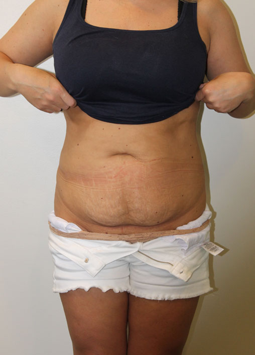 Tummy Tuck Before And After Pictures In Norwich, CT