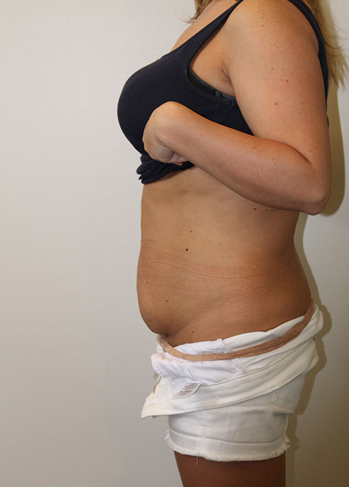 Tummy Tuck Before And After Pictures In Norwich, CT