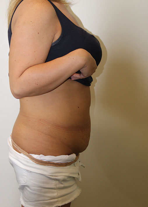 Tummy Tuck Before And After Pictures In Norwich, CT