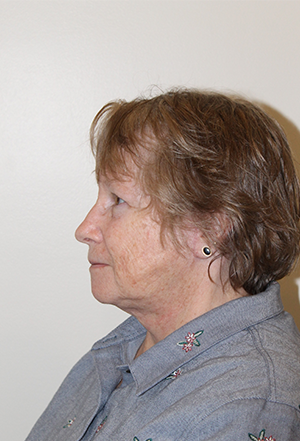 Facelift Before and After Pictures Norwich, CT
