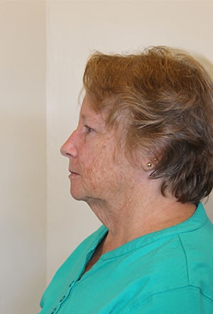 Facelift Before and After Pictures Norwich, CT