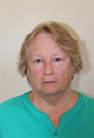 Facelift Before and After Pictures Norwich, CT