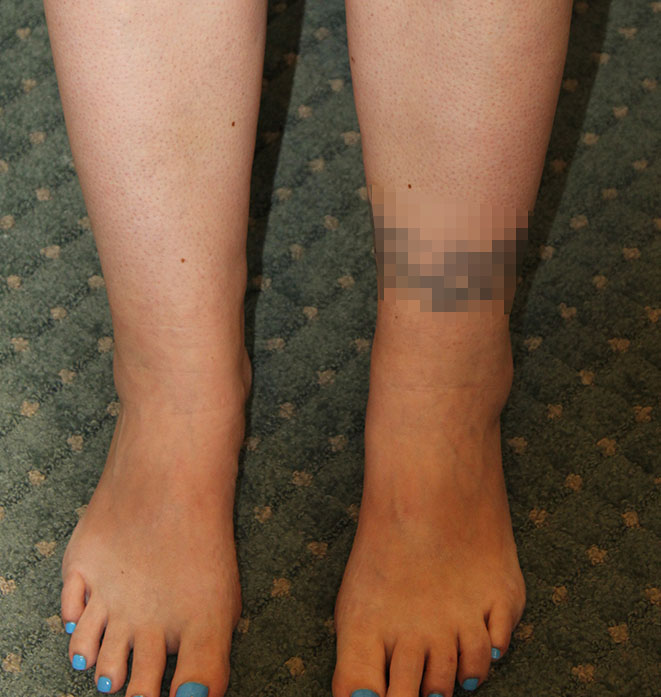 Liposuction Before and After Pictures in Norwich, CT