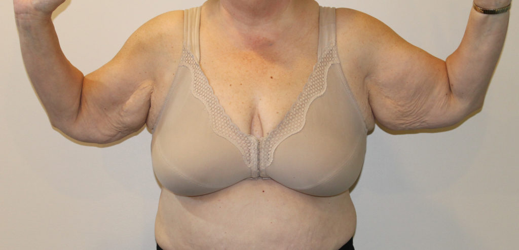 Brachioplasty Before and After Pictures Norwich, CT