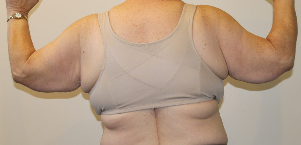 Brachioplasty Before and After Pictures Norwich, CT