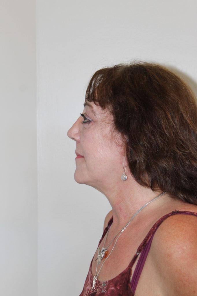 Facelift Before and After Pictures Norwich, CT