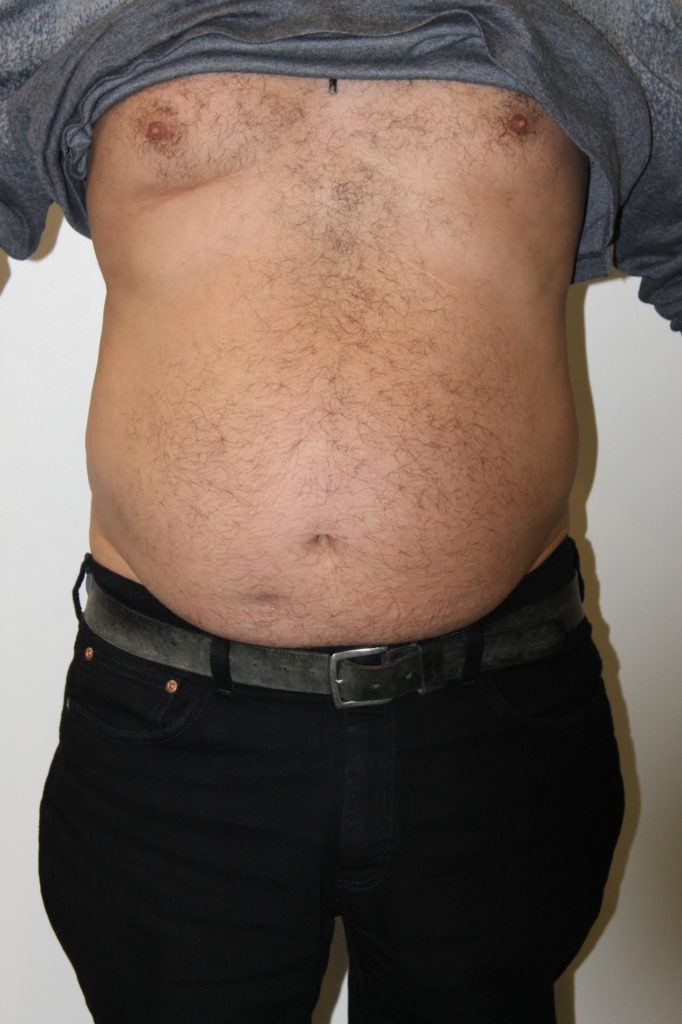Liposuction Before And After Pictures In Norwich, CT