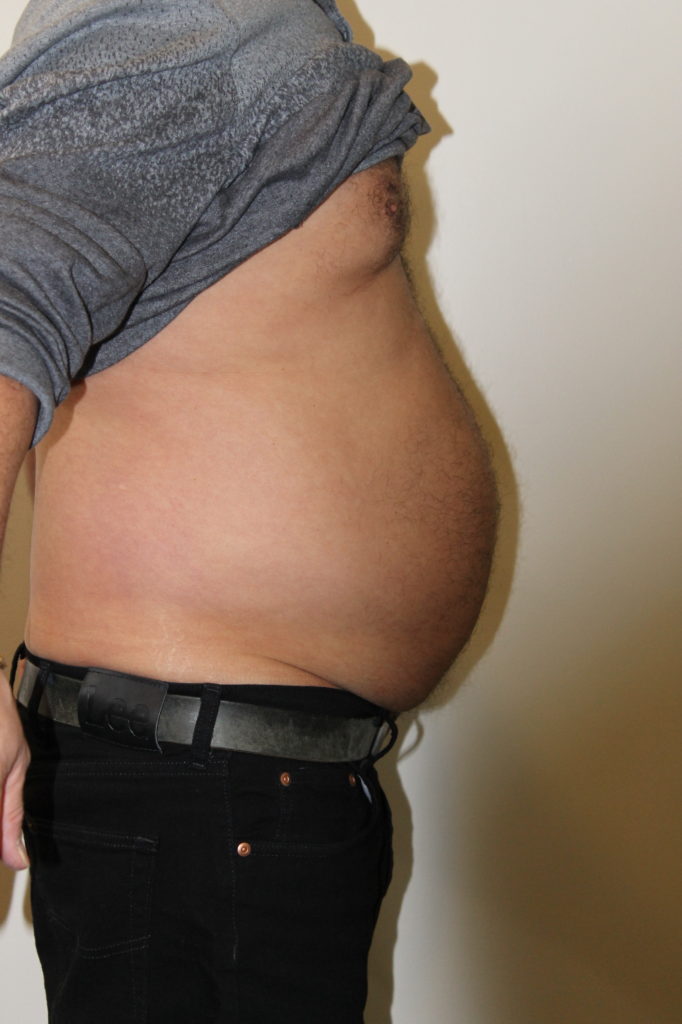 Liposuction Before And After Pictures In Norwich, CT