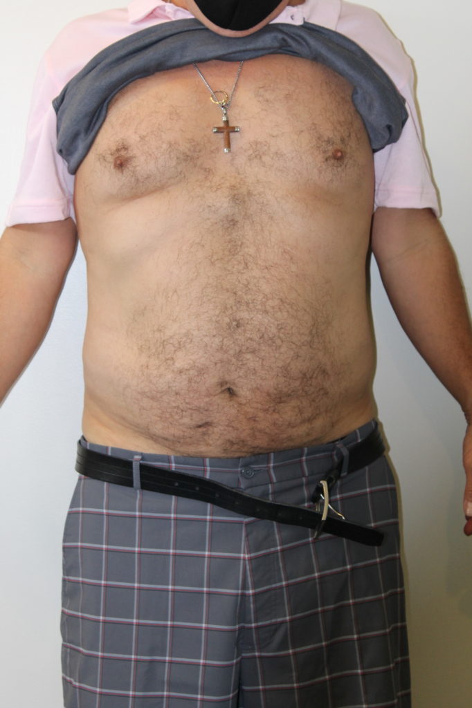 Liposuction Before And After Pictures In Norwich, CT