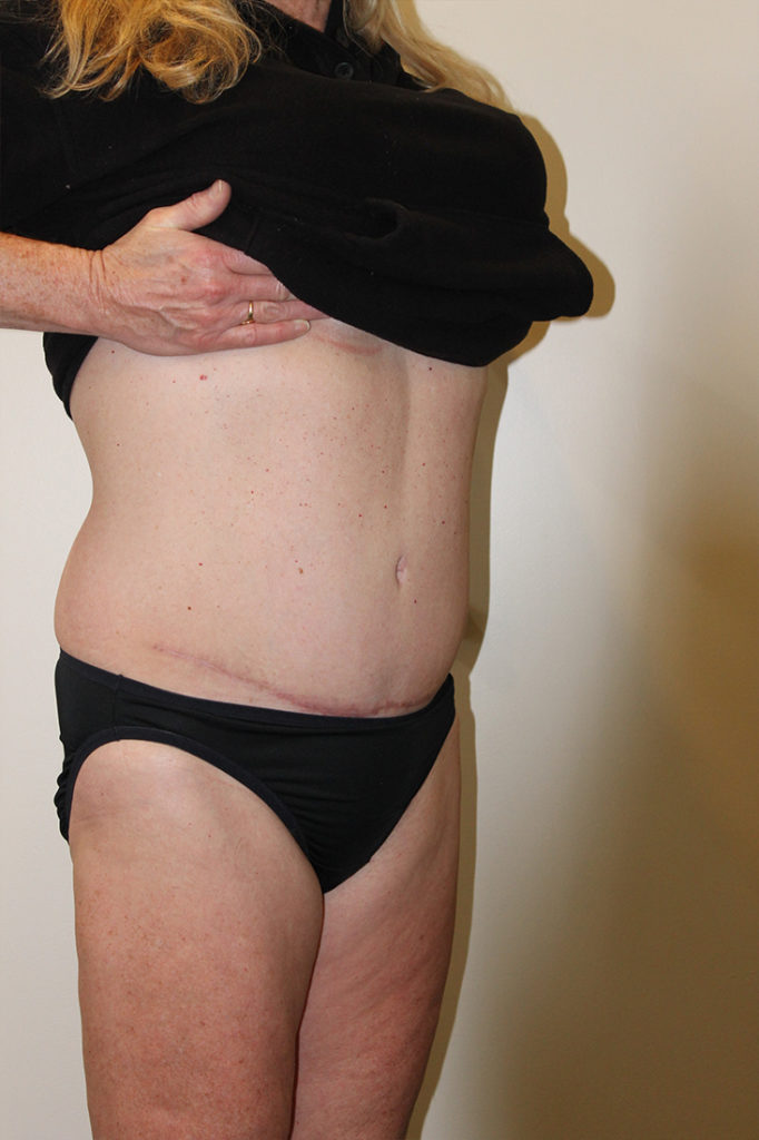 Tummy Tuck Before and After Pictures in Norwich, CT
