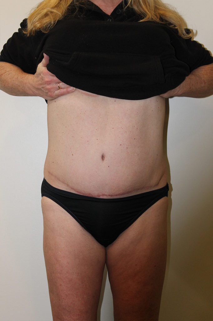 Tummy Tuck Before and After Pictures in Norwich, CT