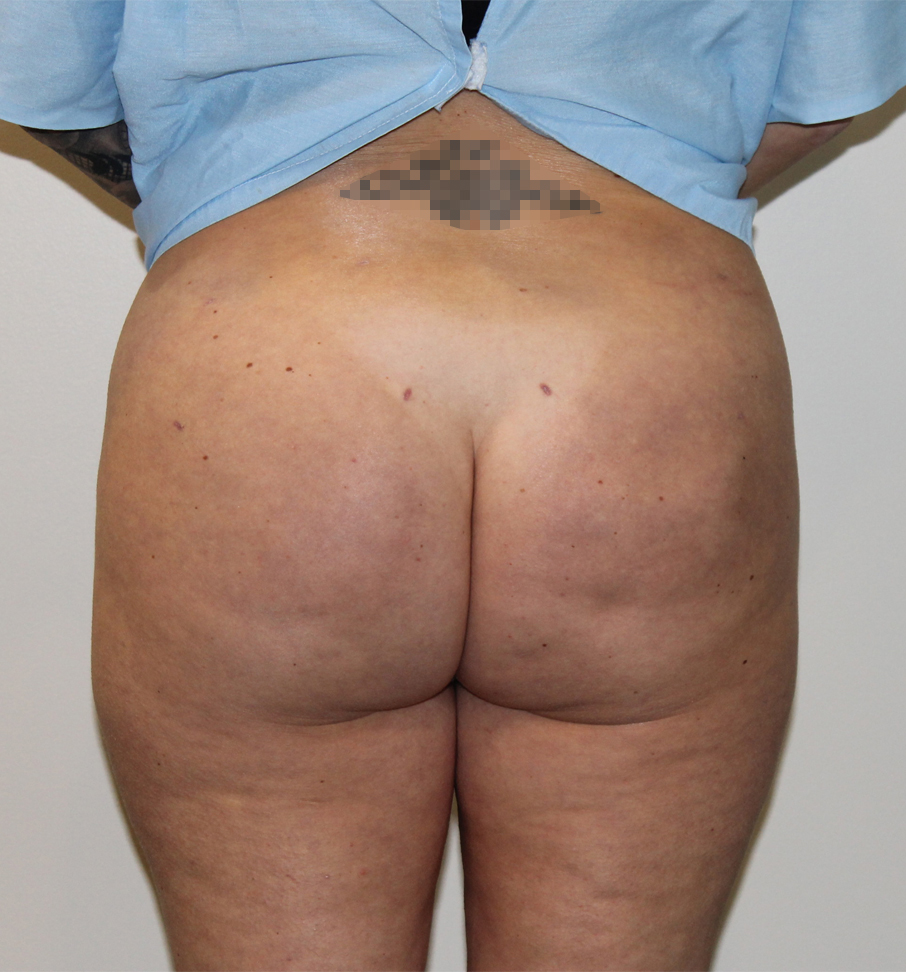 Brazilian Butt Lift Before And After Pictures In Norwich, CT