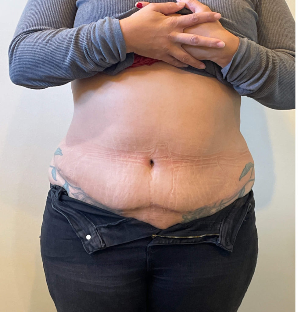 Tummy Tuck Before and After Pictures in Norwich, CT