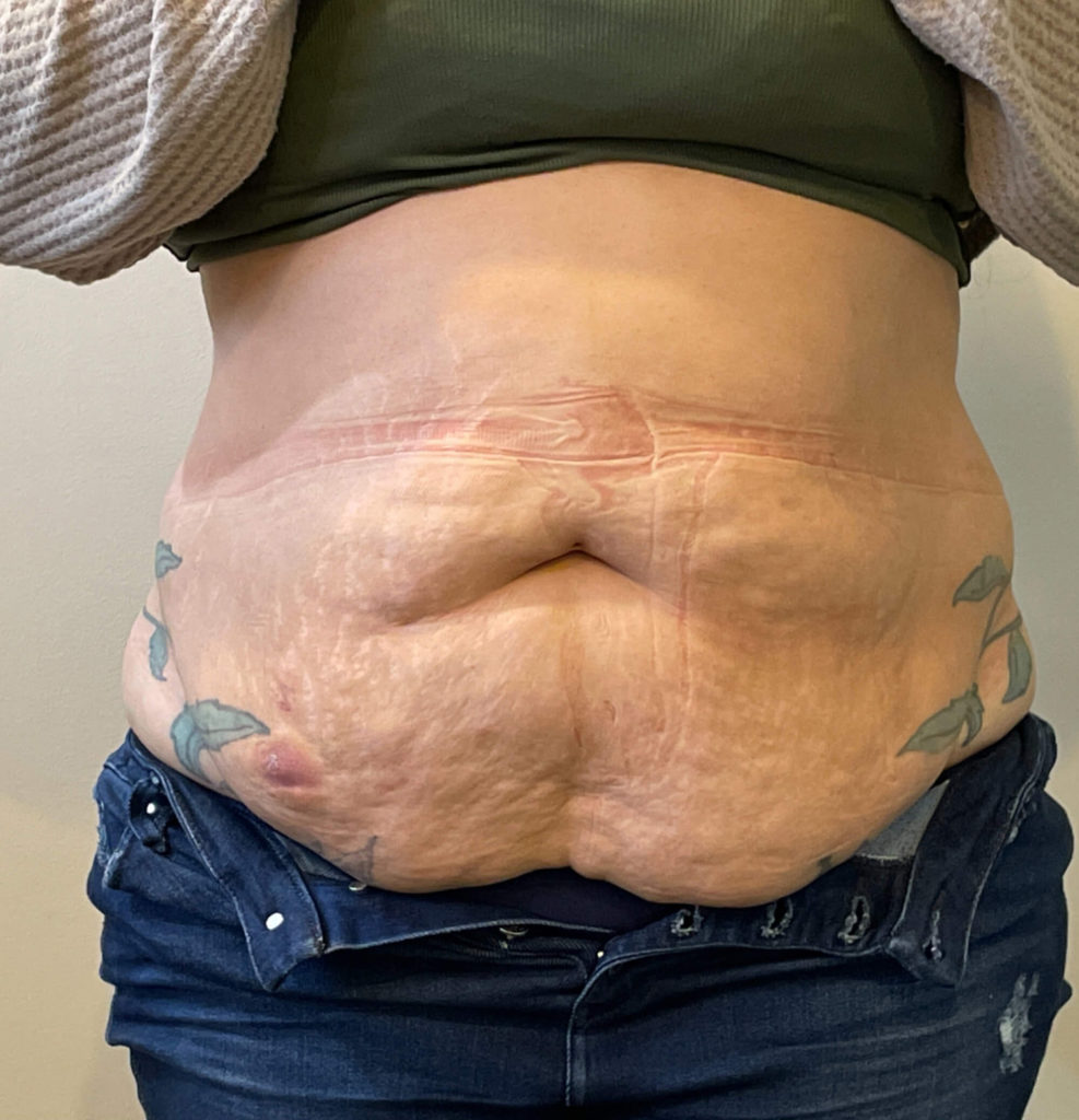 Tummy Tuck Before and After Pictures in Norwich, CT