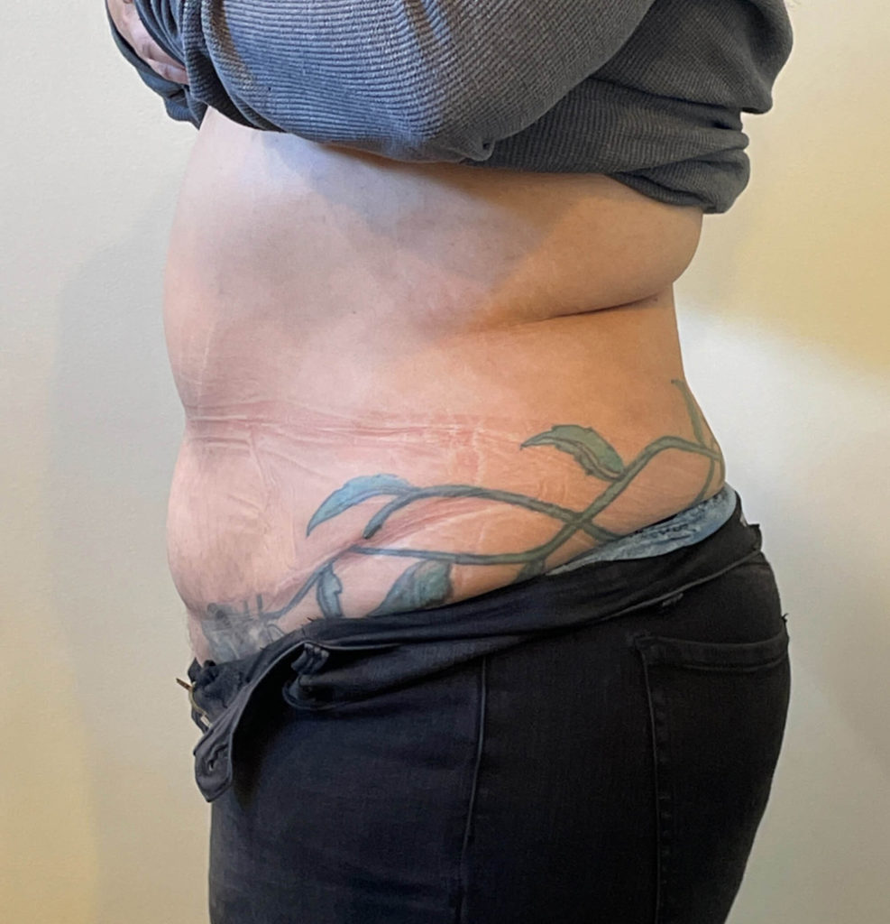 Tummy Tuck Before and After Pictures in Norwich, CT