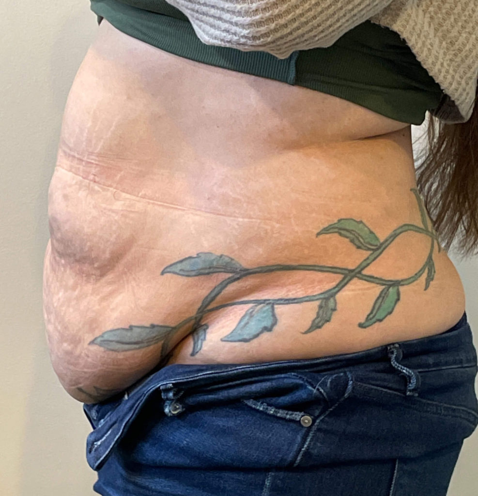 Tummy Tuck Before and After Pictures in Norwich, CT