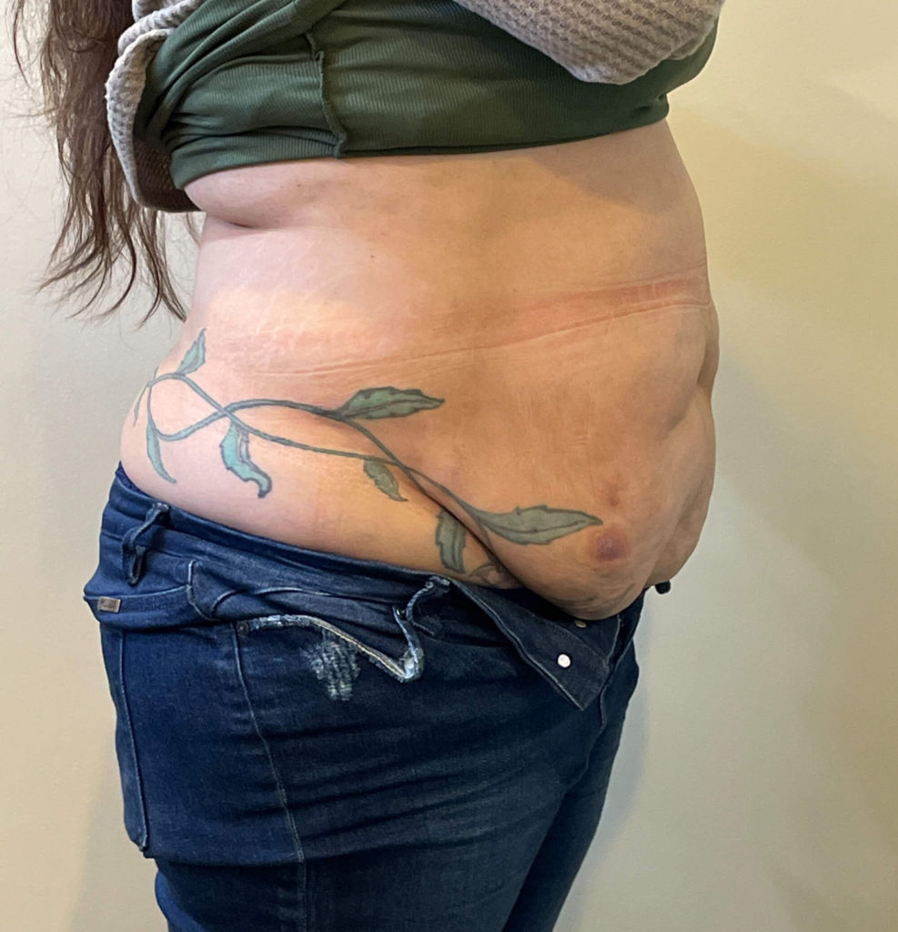 Tummy Tuck Before and After Pictures in Norwich, CT